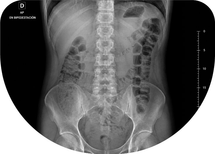 Radiografía de abdomen