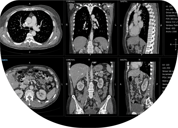 Tomografía de tórax y abdomen