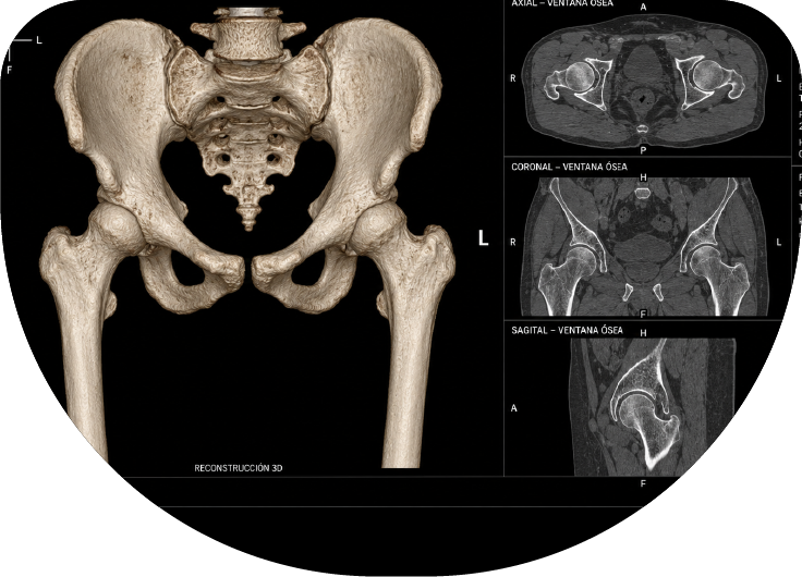 Tomografía musculoesquelética con reconstrucción 3D
