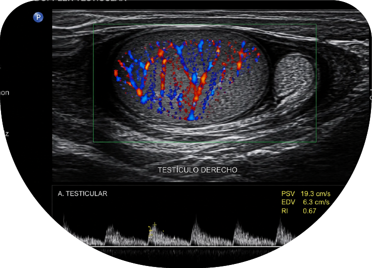 Ultrasonido Doppler testicular