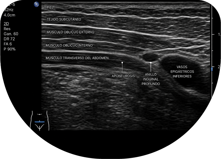 Ultrasonido de pared abdominal e inguinal