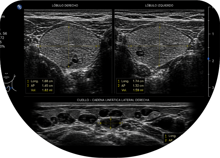 Ultrasonido de tiroides y cuello