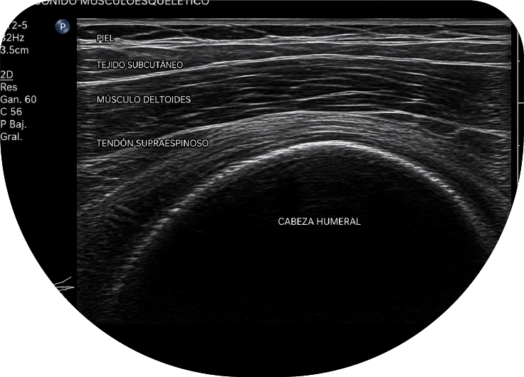 Ultrasonido musculoesquelético