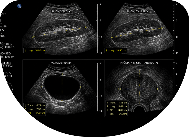 Ultrasonido renal, vesical y prostático