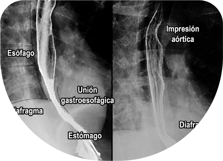 Esofagograma